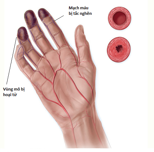 Hoại tử vô mạch – biến chứng của bệnh LOÃNG XƯƠNG. Bệnh nguy hiểm hãy khắc phục ngay