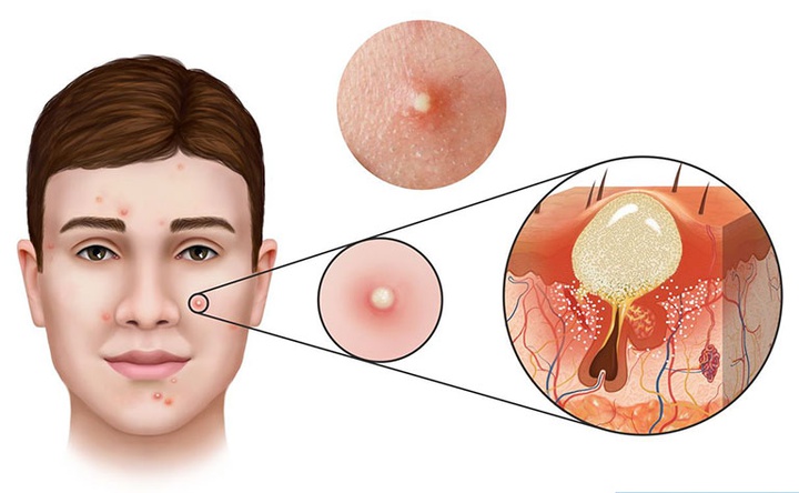 sebum là gì?